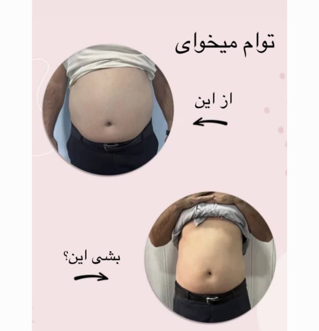 کلینیک لاغری تضمینی سایه کاهش سایز سریع در رشت